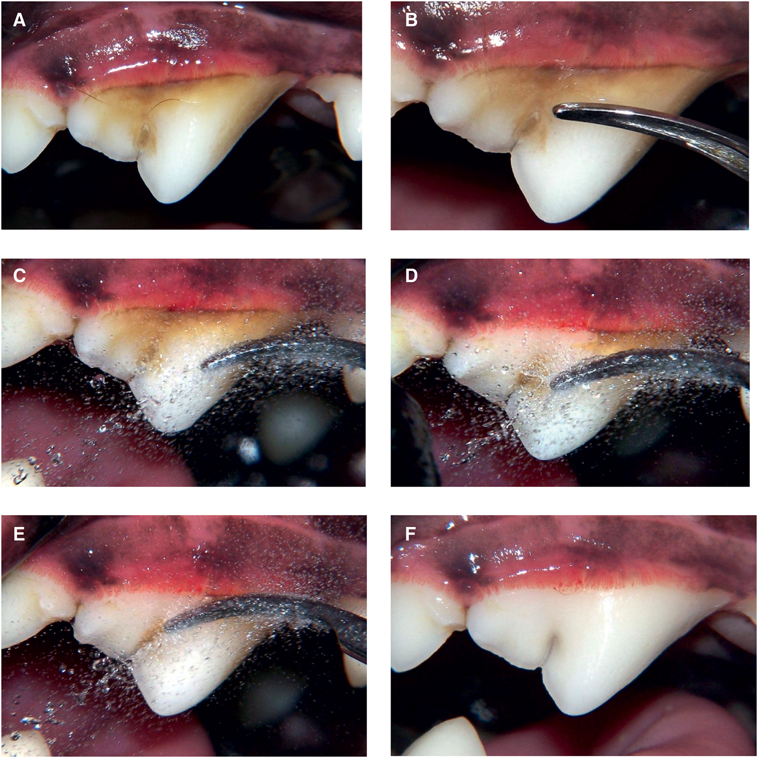 Sequence of dental cleaning