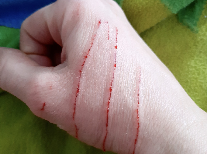 Hand bleeding from a cat scratch