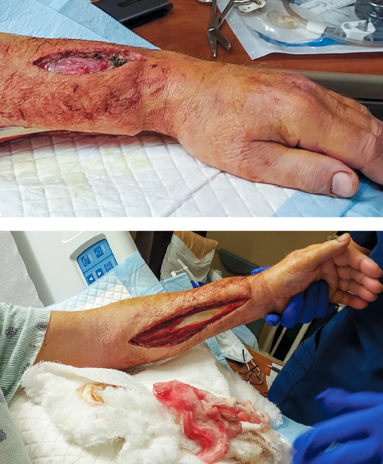 Necrotizing fasciitis wound of a cat owner's arm